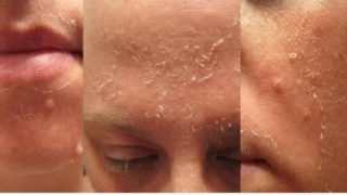 فوائد التقشير المنتظم لبشرة صحية: دليل شامل